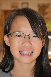 Robyn started her years of dental braces today...